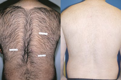 Laser Hair Removal Before & After Gallery - Patient 122405987 - Image 1