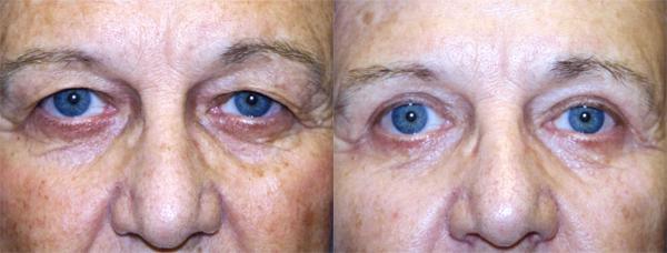 Eyelid Surgery Before & After Gallery - Patient 273263 - Image 1