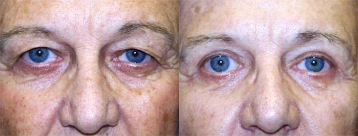 Eyelid Surgery Before & After Gallery - Patient 122405986 - Image 1