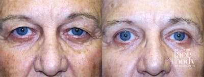 Eyelid Surgery Before & After Gallery - Patient 273263 - Image 1