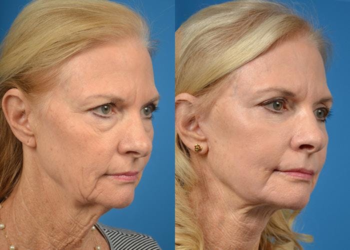 Facelift Before & After Gallery - Patient 122405988 - Image 4