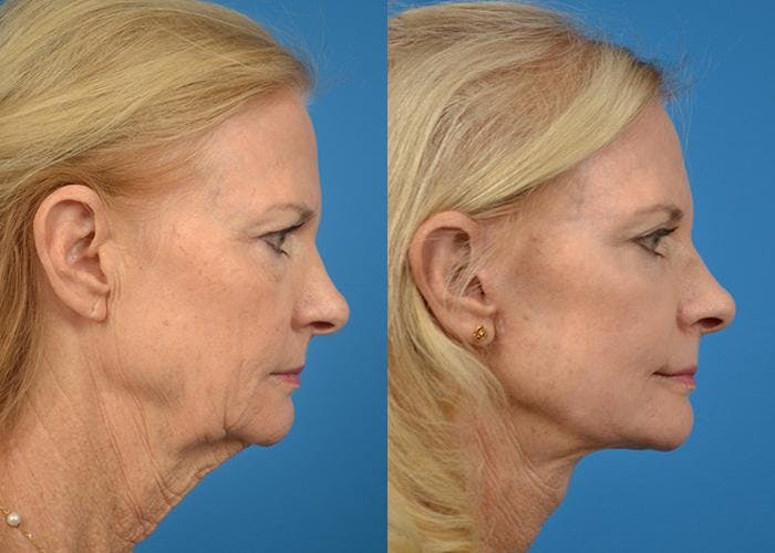 Facelift Before & After Gallery - Patient 122405988 - Image 5