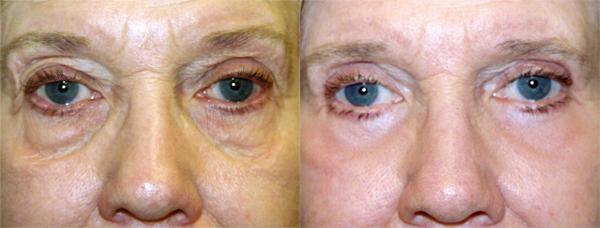 Eyelid Surgery Before & After Gallery - Patient 338098 - Image 1