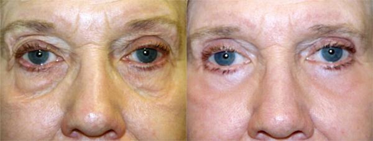 Eyelid Surgery Before & After Gallery - Patient 122405990 - Image 1
