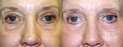 Eyelid Surgery Before & After Gallery - Patient 338098 - Image 1
