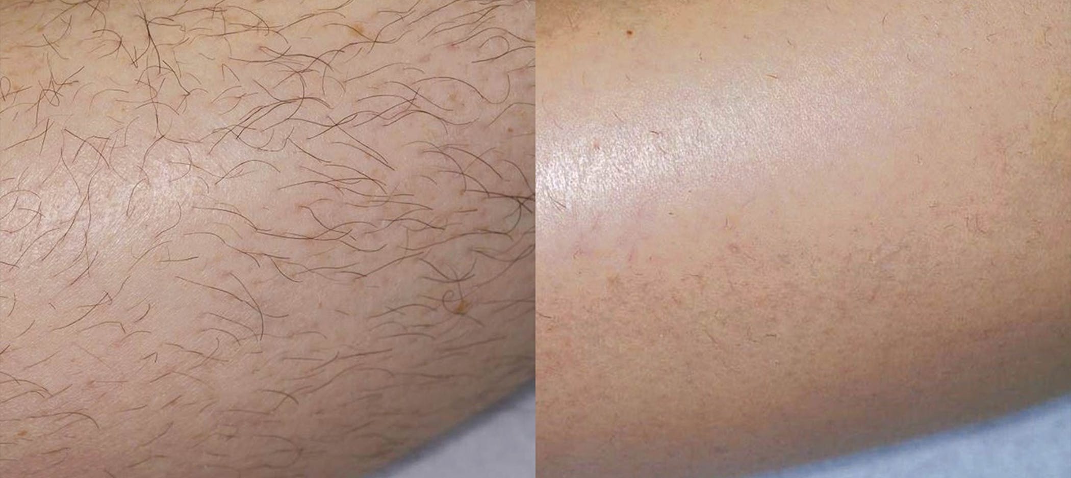 Laser Hair Removal
