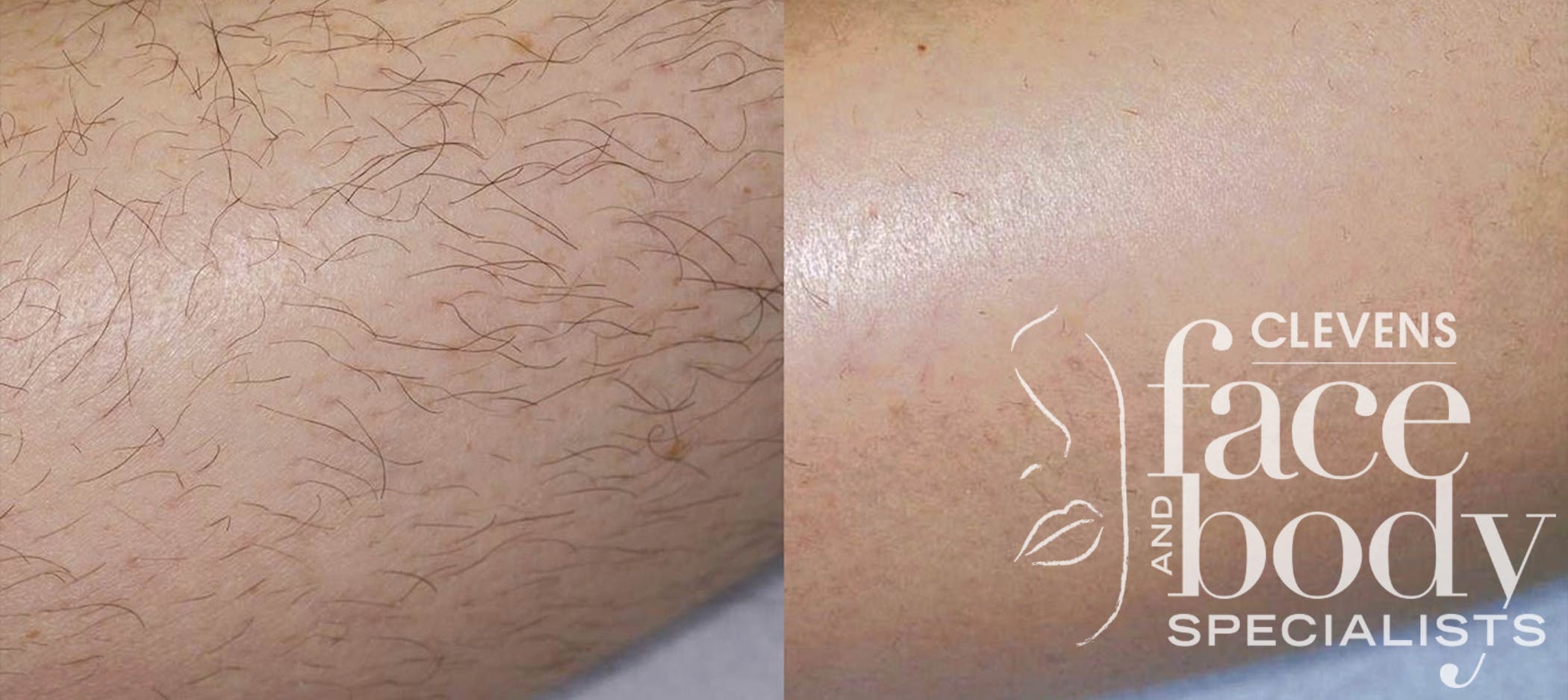 Laser Hair Removal