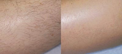 Laser Hair Removal Before & After Gallery - Patient 122405991 - Image 1