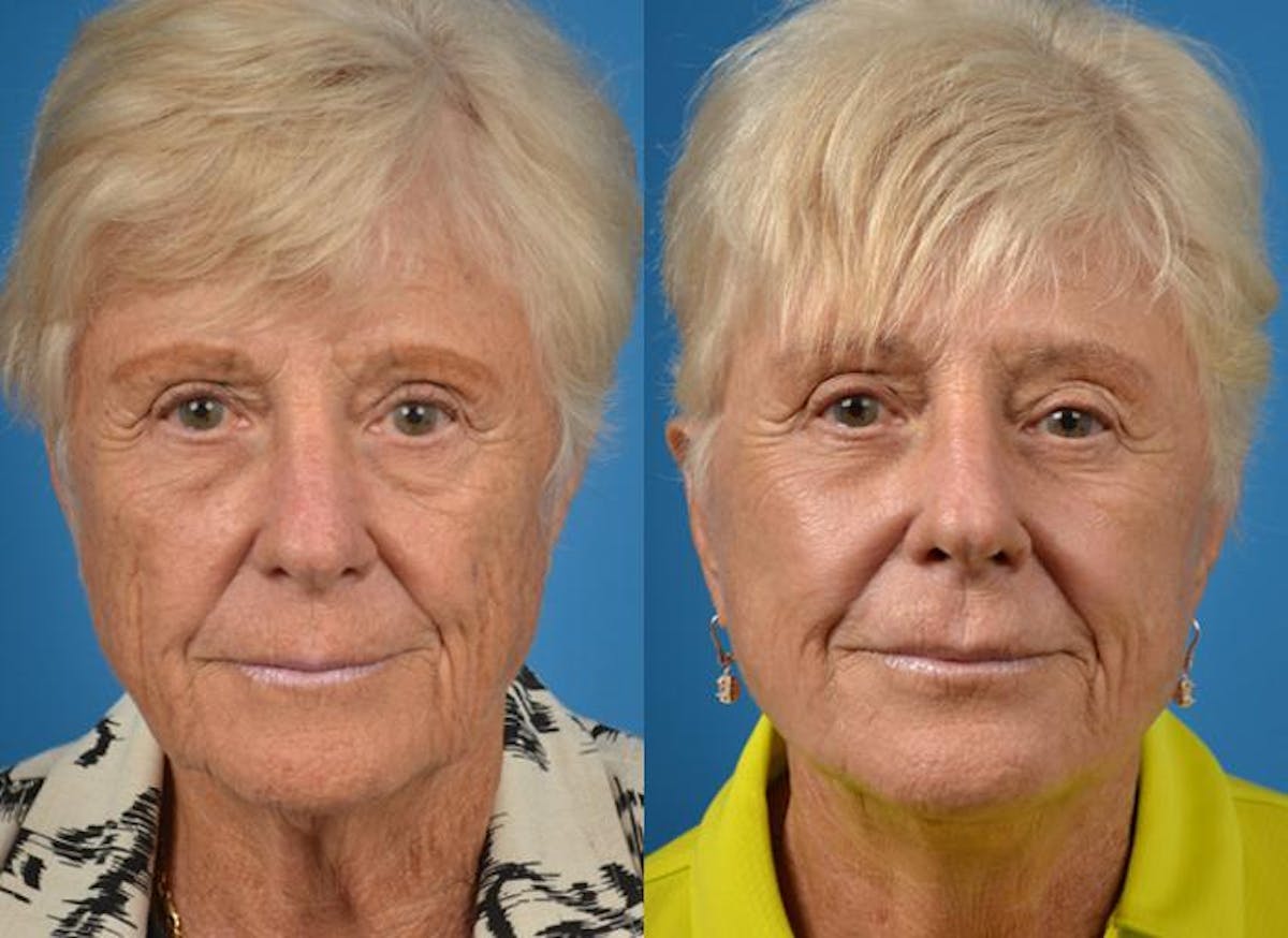 Facelift Before & After Gallery - Patient 122405996 - Image 1