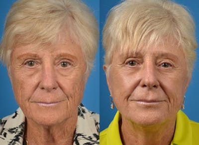 Facelift Before & After Gallery - Patient 122405996 - Image 1