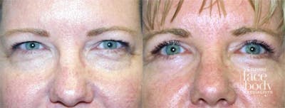 Eyelid Surgery Before & After Gallery - Patient 372233 - Image 1