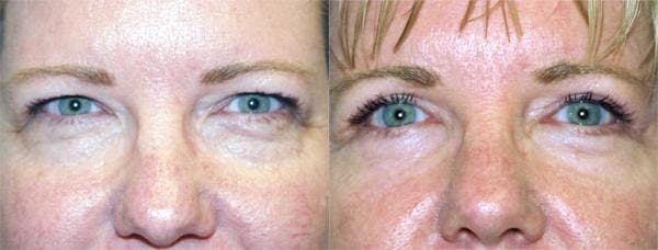 Eyelid Surgery Before & After Gallery - Patient 122405995 - Image 1