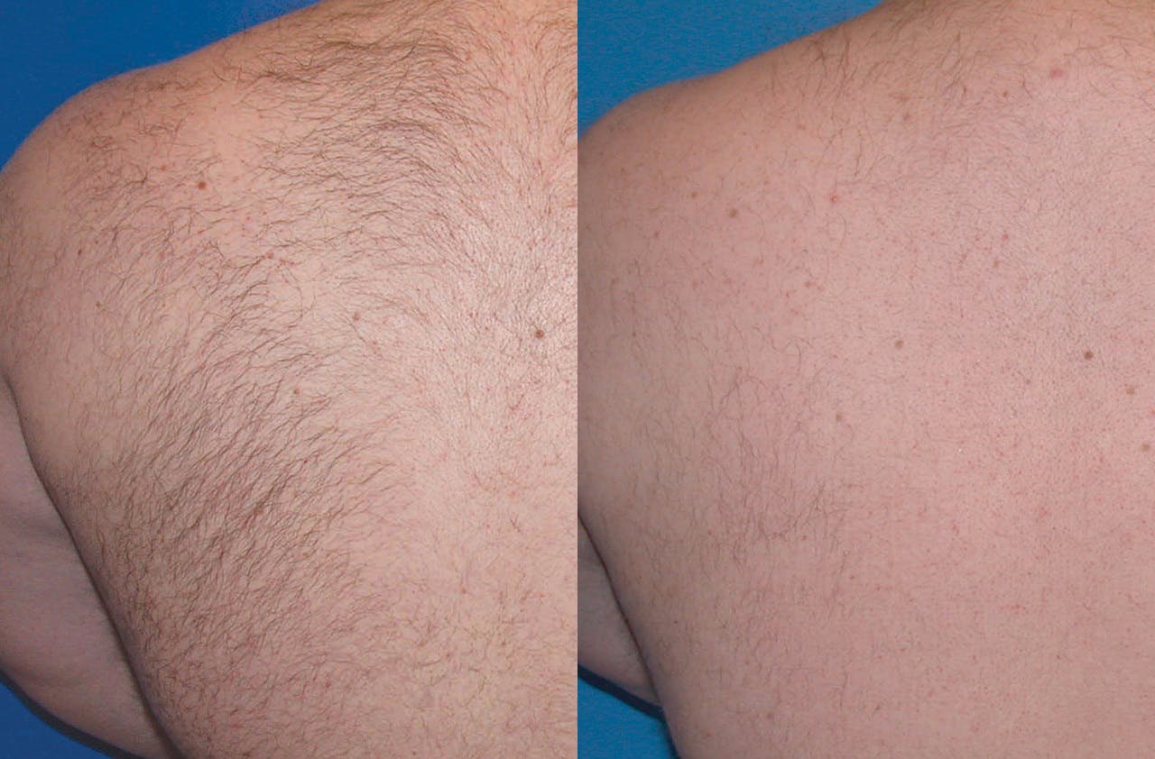 Laser Hair Removal Before & After Gallery - Patient 122405993 - Image 1