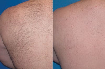 Laser Hair Removal Before & After Gallery - Patient 122405993 - Image 1