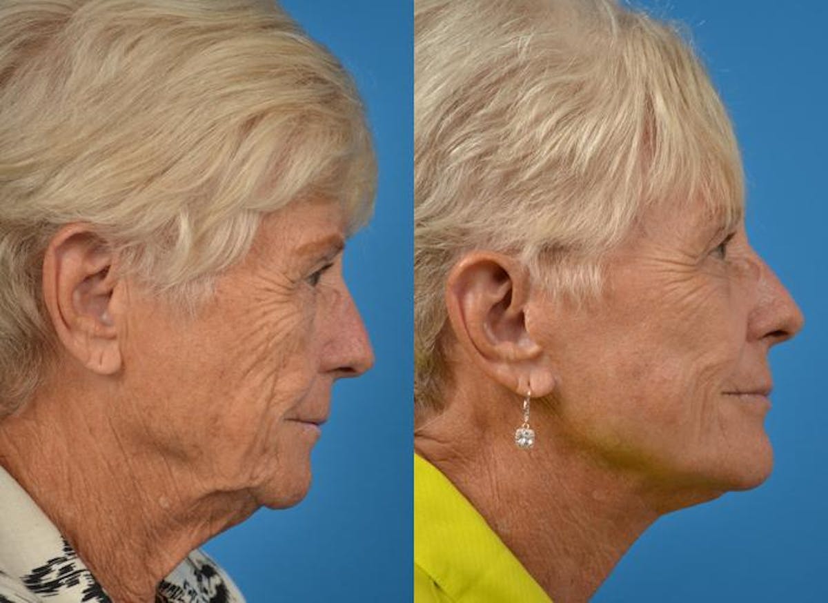 Facelift Before & After Gallery - Patient 122405996 - Image 2