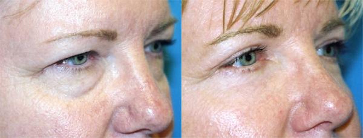 Eyelid Surgery Before & After Gallery - Patient 122405995 - Image 2