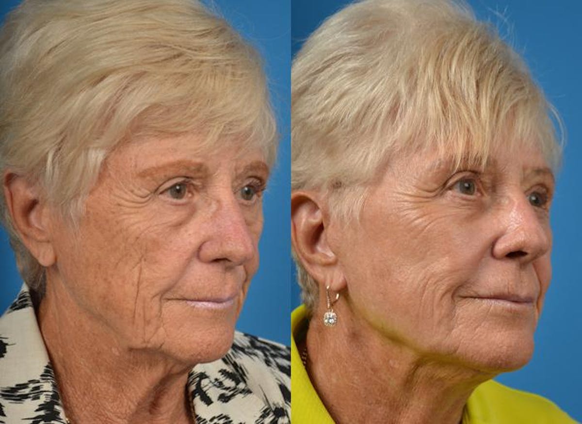 Facelift Before & After Gallery - Patient 122405996 - Image 3