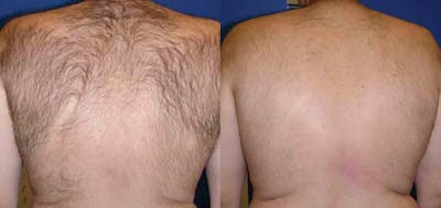 Laser Hair Removal Before & After Gallery - Patient 122405998 - Image 1