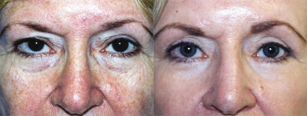 Eyelid Surgery Before & After Gallery - Patient 846393 - Image 1