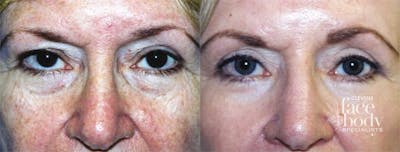 Eyelid Surgery Before & After Gallery - Patient 846393 - Image 1