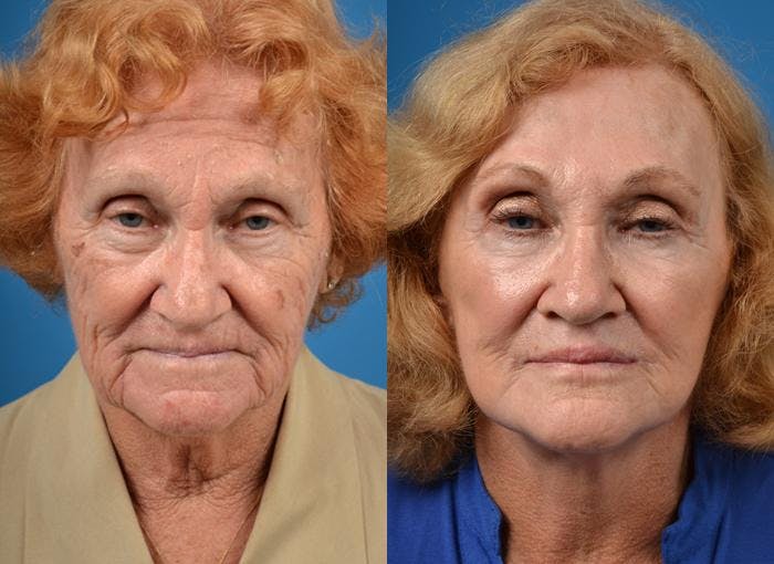 Facelift Before & After Gallery - Patient 122406003 - Image 1