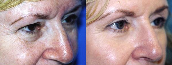 Eyelid Surgery Before & After Gallery - Patient 122406000 - Image 2