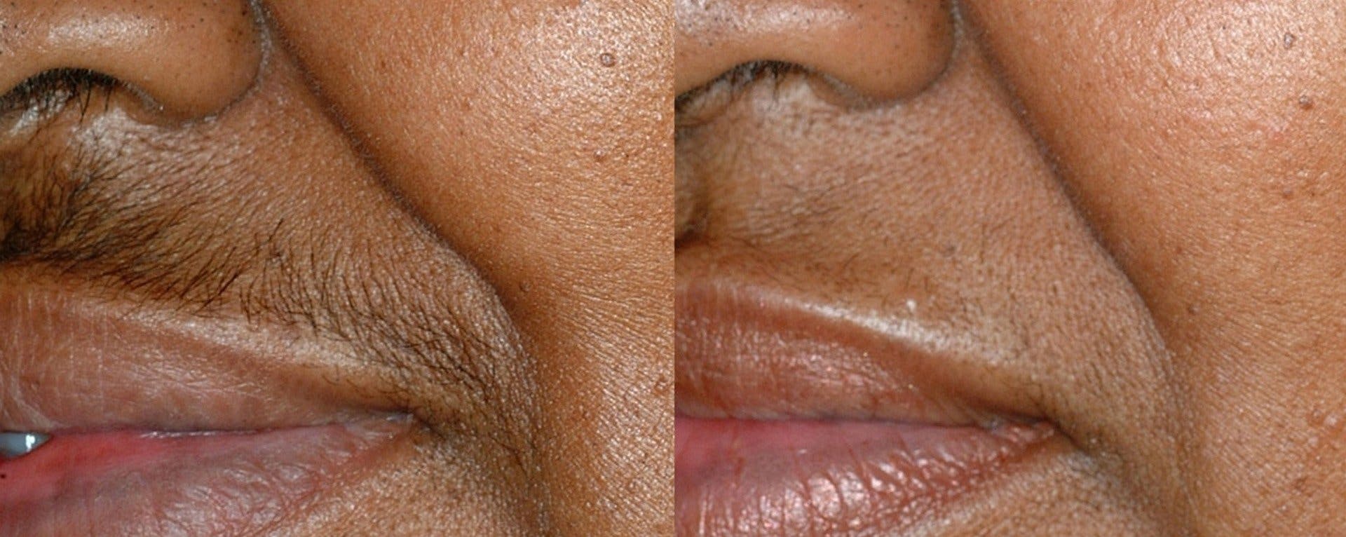 Laser Hair Removal Before & After Gallery - Patient 122406001 - Image 1