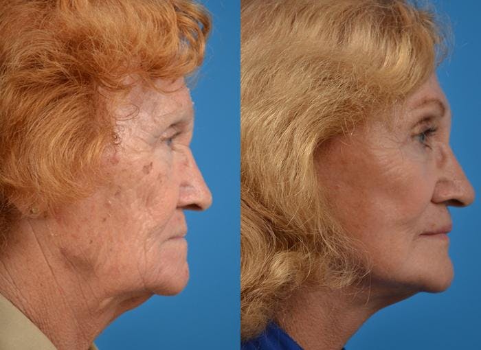 Facelift Before & After Gallery - Patient 122406003 - Image 2
