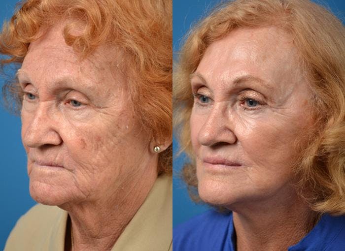 Facelift Before & After Gallery - Patient 122406003 - Image 3