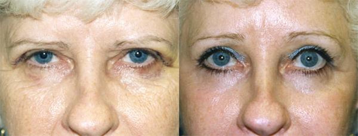 Eyelid Surgery Before & After Gallery - Patient 122406005 - Image 1