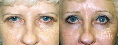 Eyelid Surgery Before & After Gallery - Patient 416717 - Image 1