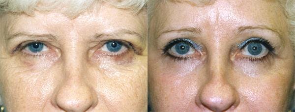 Eyelid Surgery Before & After Gallery - Patient 122406005 - Image 1