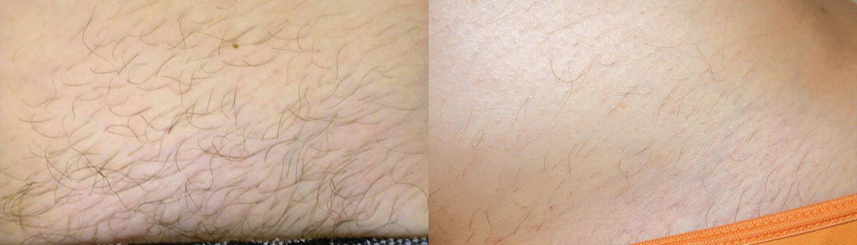 Laser Hair Removal Before & After Gallery - Patient 122406004 - Image 1