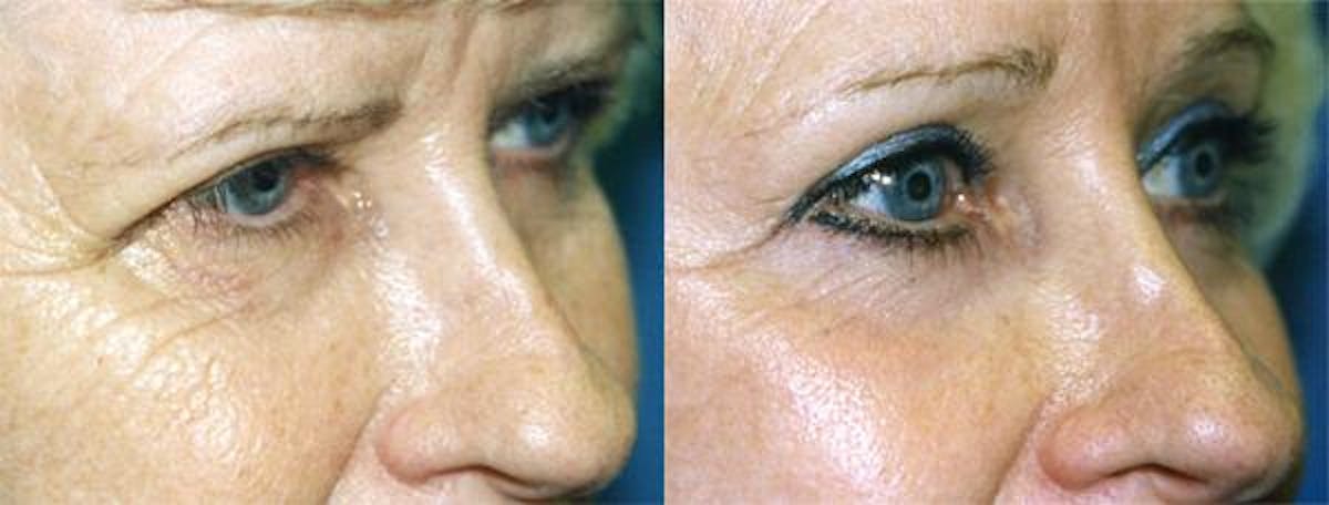 Eyelid Surgery Before & After Gallery - Patient 122406005 - Image 2
