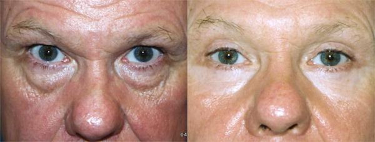 Eyelid Surgery Before & After Gallery - Patient 122406008 - Image 1