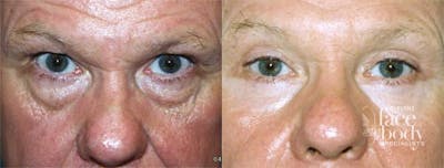 Eyelid Surgery Before & After Gallery - Patient 291949 - Image 1