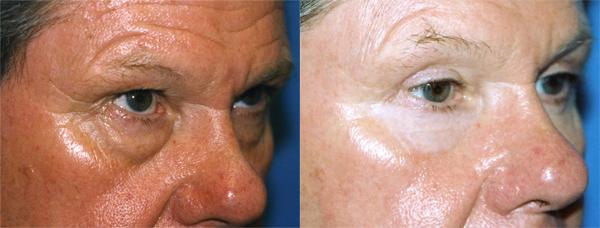 Eyelid Surgery Before & After Gallery - Patient 291949 - Image 2