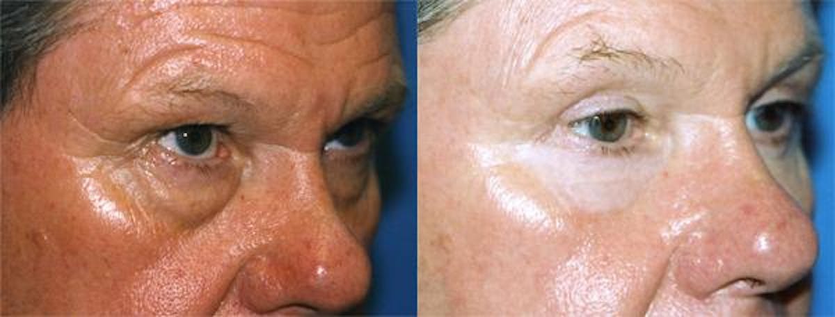 Eyelid Surgery Before & After Gallery - Patient 122406008 - Image 2