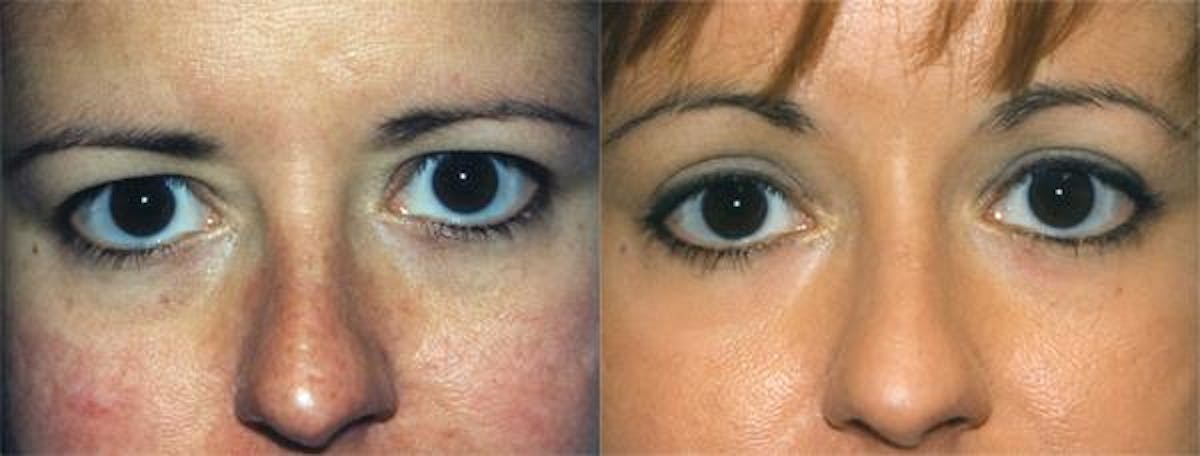 Eyelid Surgery Before & After Gallery - Patient 122406009 - Image 1