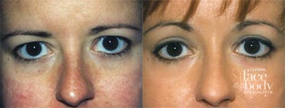 Eyelid Surgery Before & After Gallery - Patient 362004 - Image 1