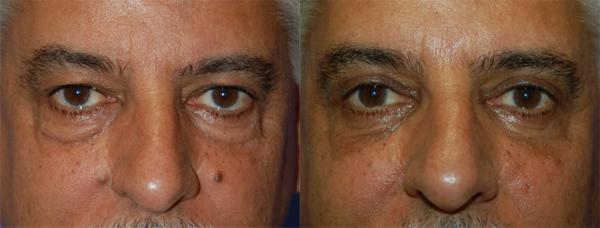 Eyelid Surgery Before & After Gallery - Patient 359535 - Image 1