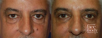 Eyelid Surgery Before & After Gallery - Patient 359535 - Image 1