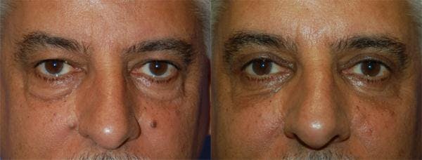 Eyelid Surgery Before & After Gallery - Patient 122406012 - Image 1