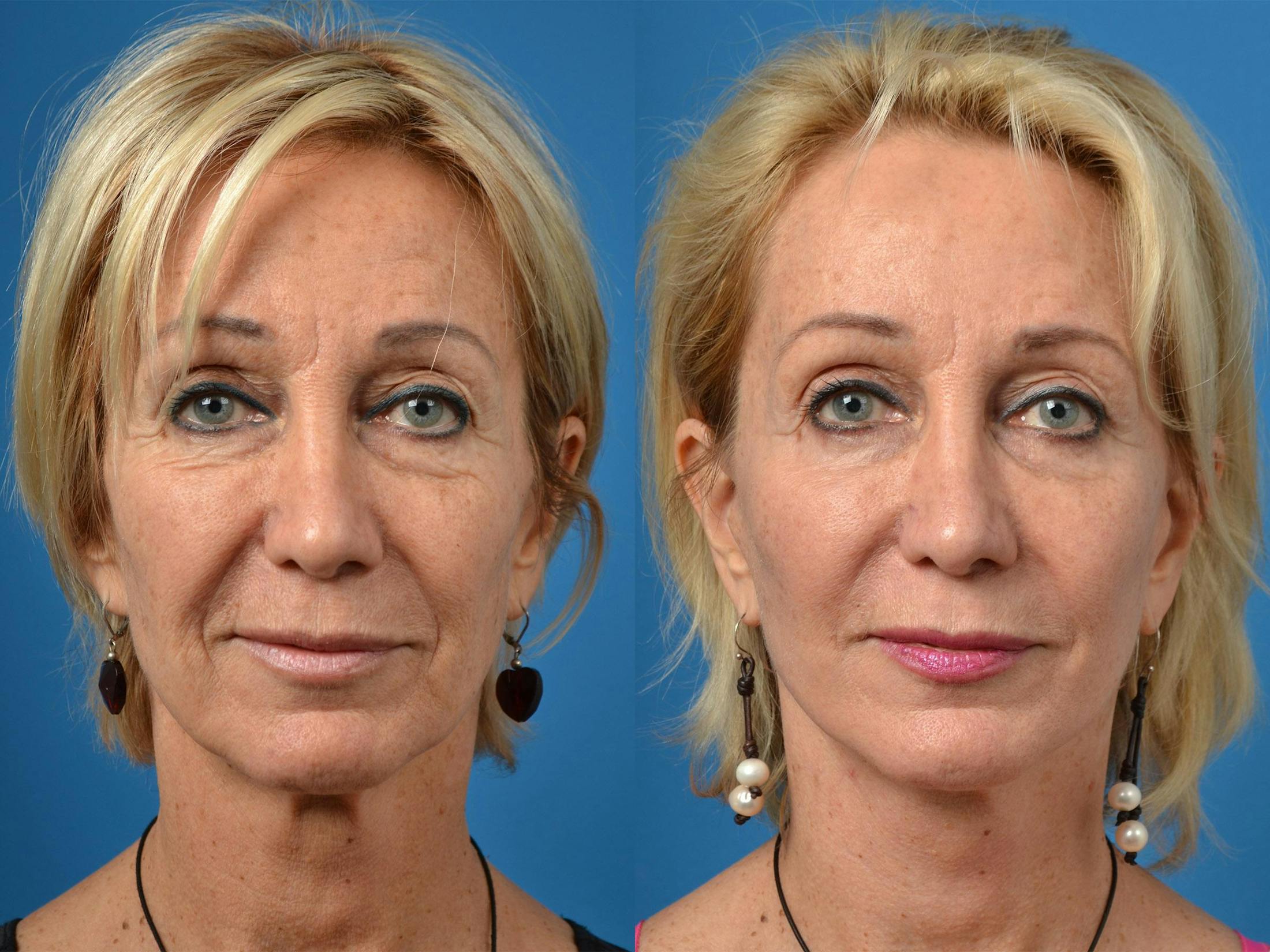 Facelift Before & After Gallery - Patient 122406015 - Image 1
