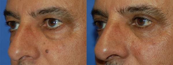Eyelid Surgery Before & After Gallery - Patient 359535 - Image 2