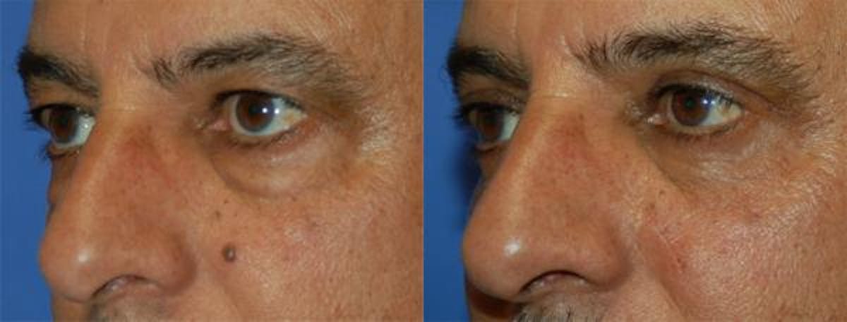 Eyelid Surgery Before & After Gallery - Patient 122406012 - Image 2