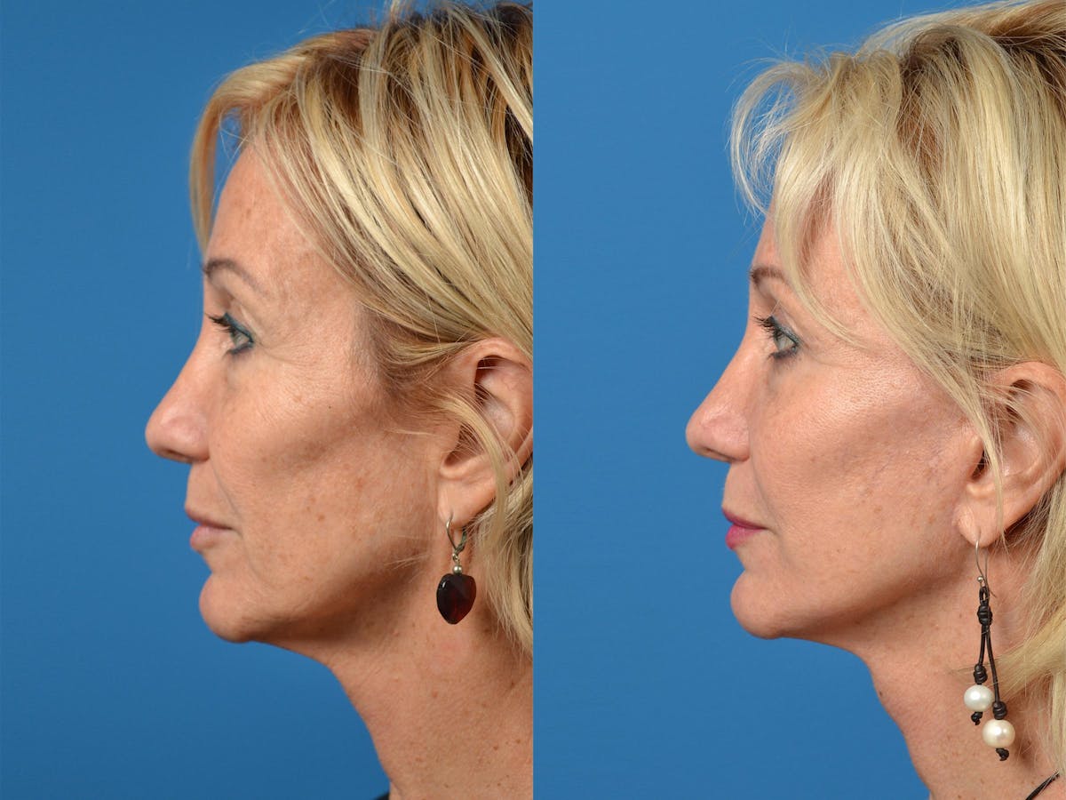 Facelift Before & After Gallery - Patient 122406015 - Image 2