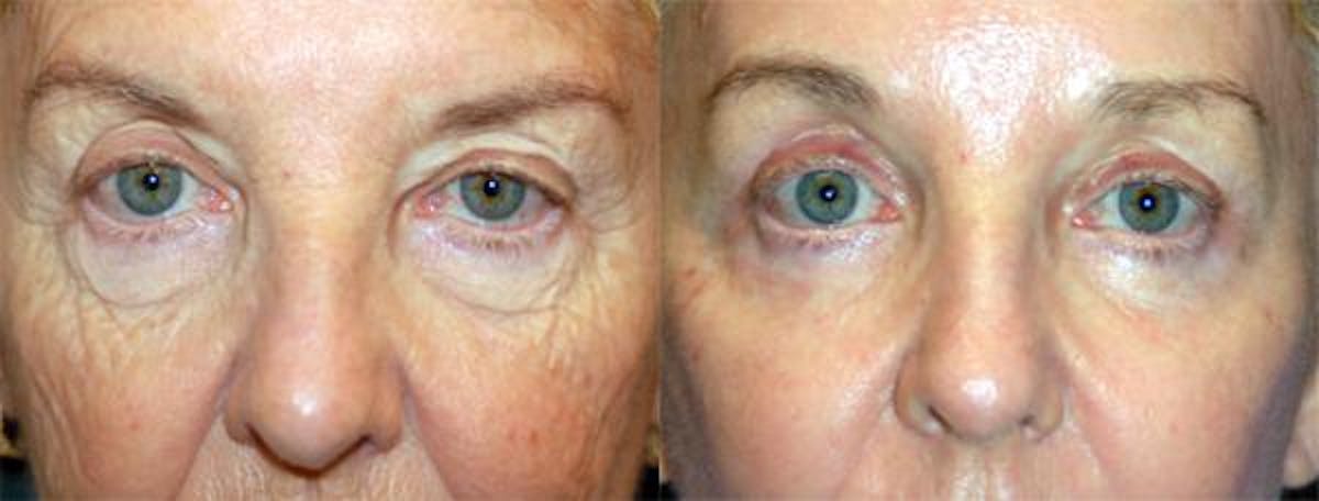 Eyelid Surgery Before & After Gallery - Patient 122406013 - Image 1