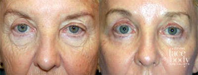 Eyelid Surgery Before & After Gallery - Patient 151005 - Image 1