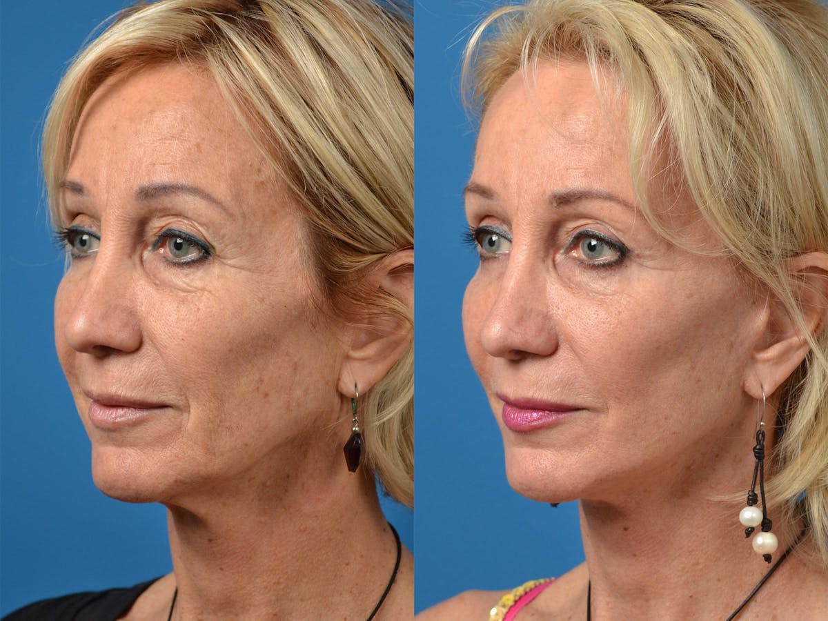 Facelift Before & After Gallery - Patient 122406015 - Image 3